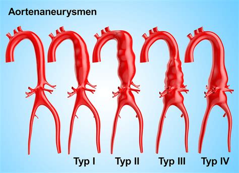 das aorten aneurysma notfall  der hauptschlagader hgz bad bevensen