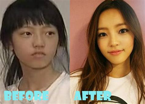 Goo Hara Plastic Surgery Before And After Picture Lovely