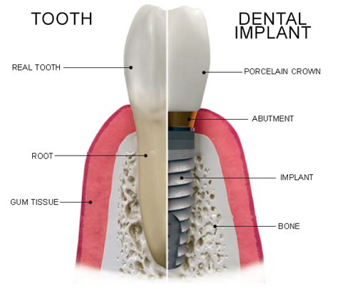dental implants oceanview dental implants