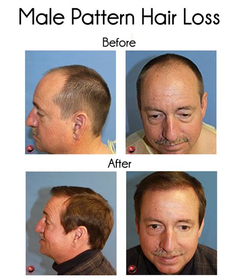 los angeles hair restoration clinic predicts  hair loss sufferers   hair