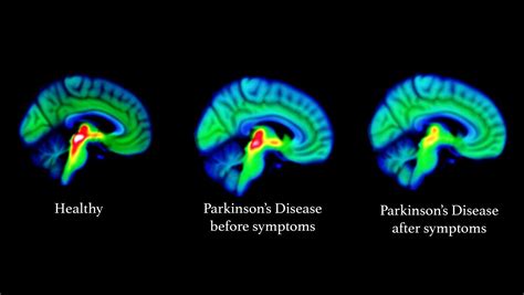 parkinsons disease brain malfunction evident  scans potentially