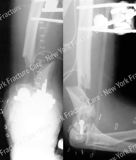 elbow fractures  york fracture care