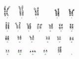 Trisomy Chromosome Karyotype Twin Crg Genetic Copies sketch template