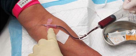 prp injection platelets rich plasma