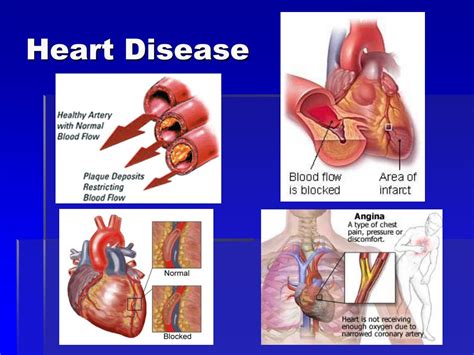heart disease powerpoint    id