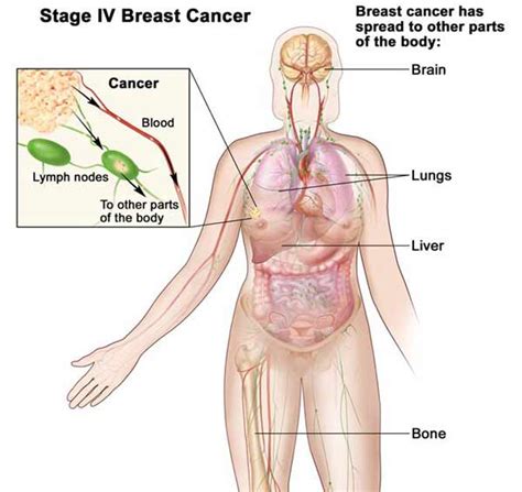 Alternative Breast Cancer Treatment What Works What Doesnt Work
