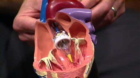heart catheterization youtube