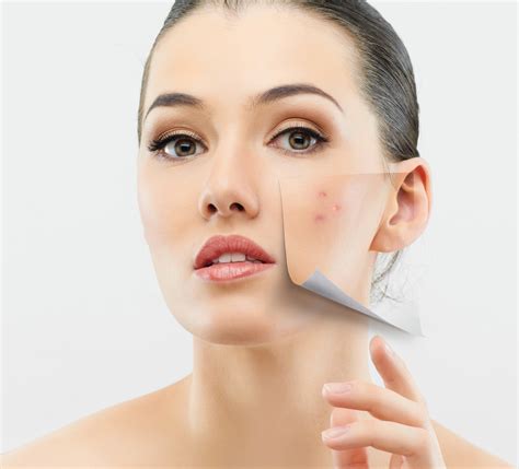 Types Of Acne Scars And Treatment Options Apex Dermatology And Skin