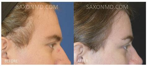 brow bone reduction austin facial feminization surgery austin