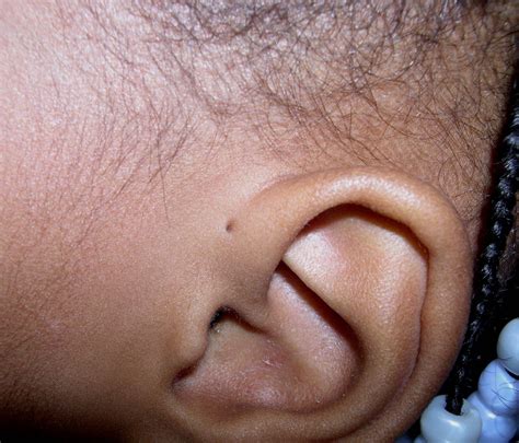 preauricular pits overview