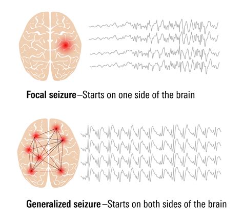 types  seizures