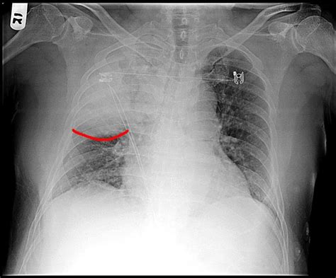 Medical Addicts Chest X Ray The Bulging Fissure Sign