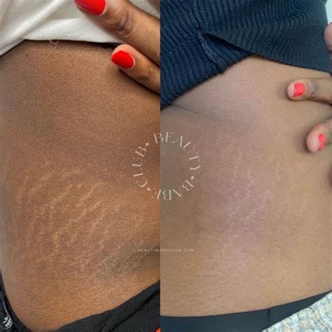 Inkless Stretch Mark Removal And Revision Isr Treatment