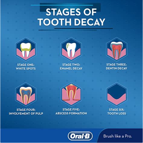 stages  tooth decay oral
