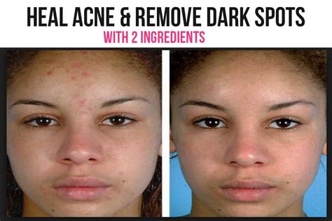 heal acne and reduce dark spots naturally quick and effective natural