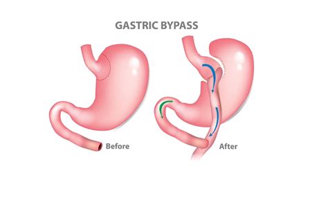 Mini Gastric Bypass Surgery And Gastric Bypass Surgery