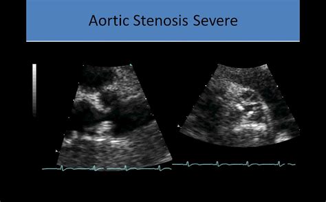 Ultrasound Registry Review Aortic Stenosis