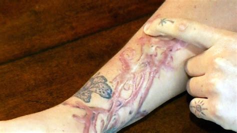 montreal woman claims tattoo removal treatment resulted in 2nd degree burns ctv news
