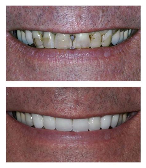 Dental Implants Before And After Bartholomew Dentist