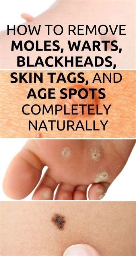 how to remove moles warts blackheads skin tags and age