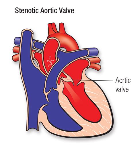 Aortic Valve Stenosis Avs And Congenital Defects American Heart