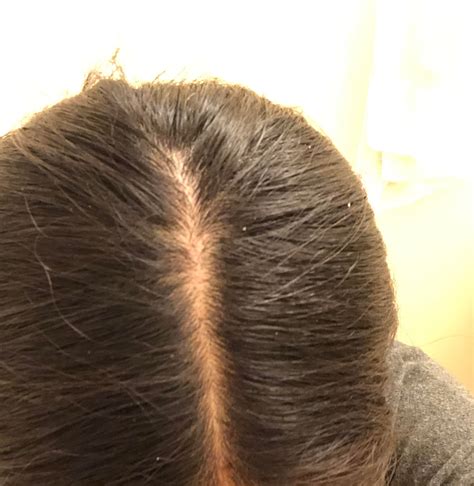 top 48 image normal hair part vs thinning vn