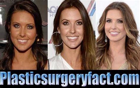 Audrina Patridge Plastic Surgery Before And After