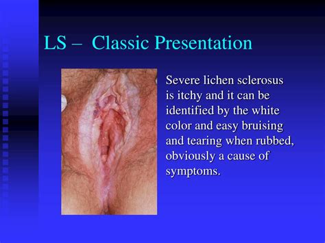 Ppt Vulvodynia Powerpoint Presentation Id 348787