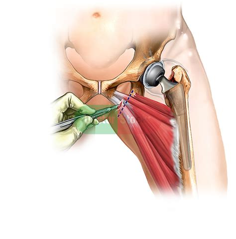 Percutaneous Hip Adductor Release Doctor Stock