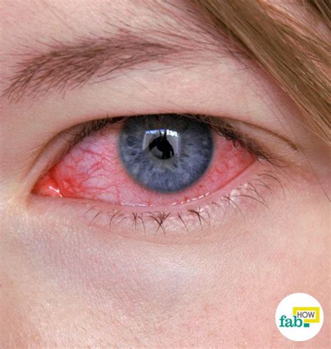 rid  pink eye conjunctivitis  antibiotics fab
