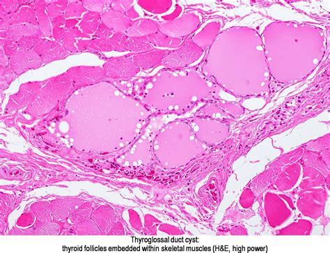 pathology outlines thyroglossal duct cyst