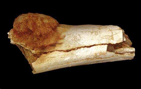 earliest human cancer    million year  fossil  science explorer