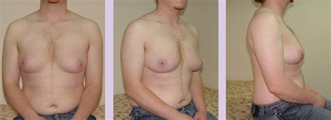 male breast feminization