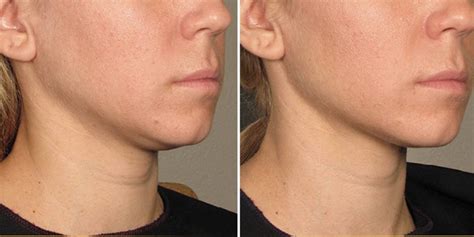 what is ultherapy and how much does it cost skin tightening