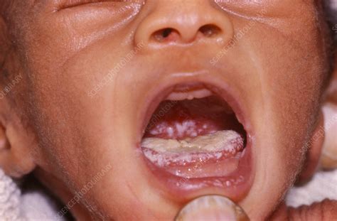 oral thrush  aids baby stock image  science photo library