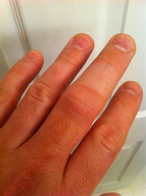 signs symptoms broken finger