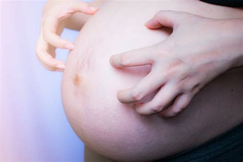 perut gatal  hamil penyebab   tepat mengatasinya good