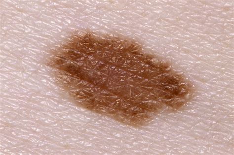 Melanoma Symptoms Abcde Doctor Heck