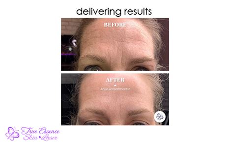 wrinkle reduction and skin tightening true essence skin and laser med spa