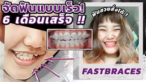 24 จัด ฟัน ฟัน ล่าง คร่อม ฟัน บน ราคา 12 2023 Vik News