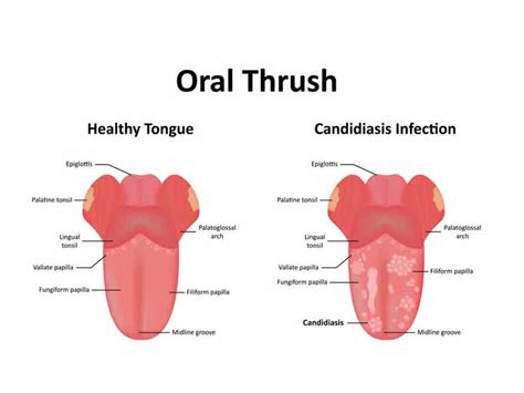 normal tongue vs thrush