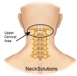 rheumatoid arthritis neck rheumatoid arthritis   cervical spine