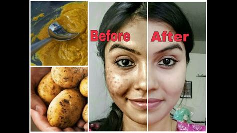 remove dark spots caused  pimples  home home