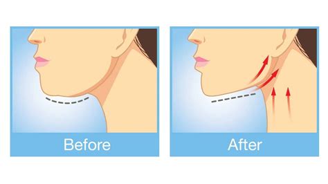 The 7 Most Effective Methods To Get Rid Of A Double Chin
