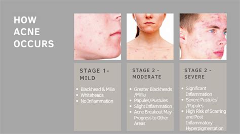 Acne And Acne Scars Lesprit Medical Clinic