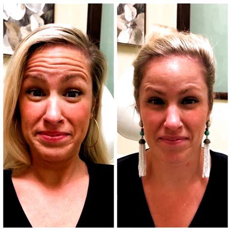 botox before and after botox before and after botox face