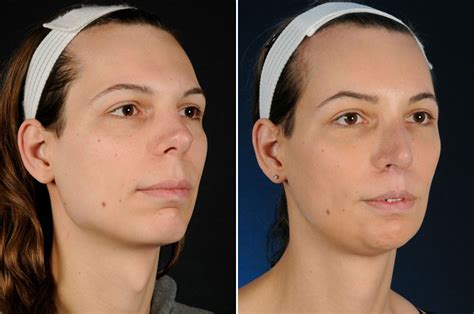 valerie before and after ffs 2pass clinic