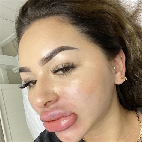 Anna Paul Shares Painful Tiktok Video Of Lip Filler Being Dissolved