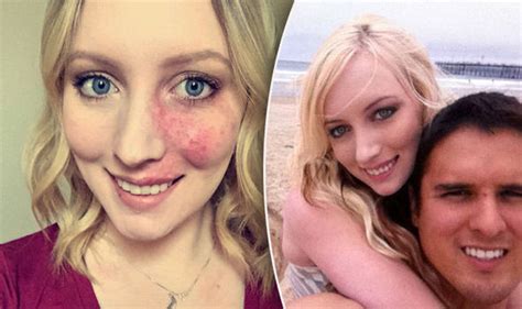girl with birthmark shows her face after finding love life life and style uk