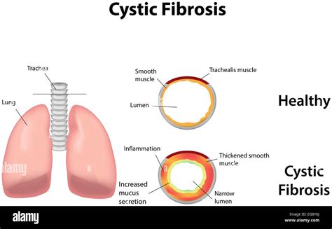 Cystic Fibrosis Stock Vector Art And Illustration Vector